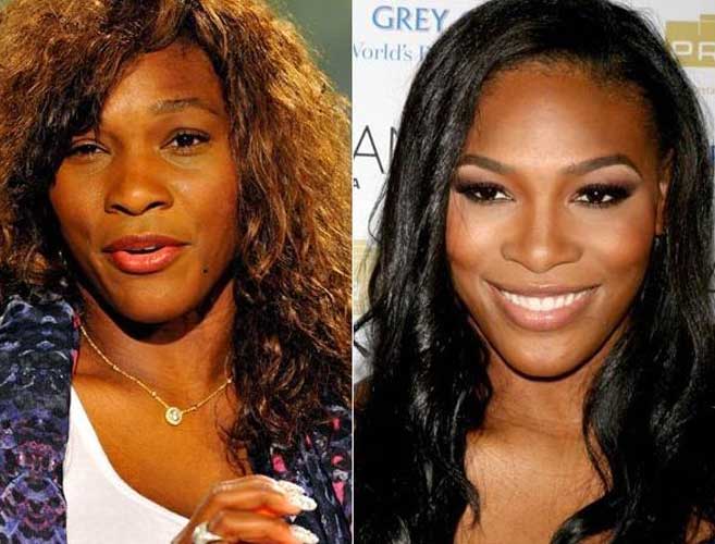 Serena williams plastic surgery