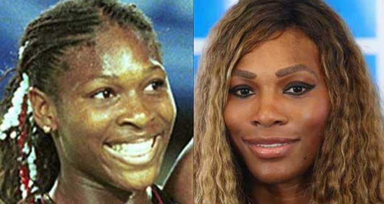 Serena williams plastic surgery