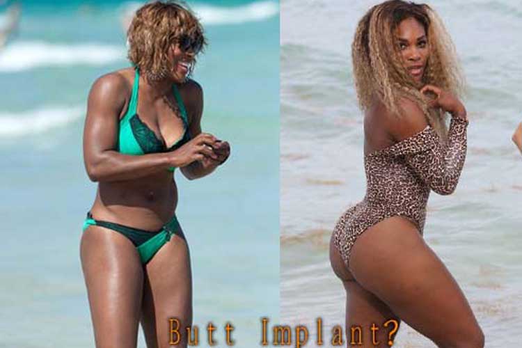 Serena williams plastic surgery