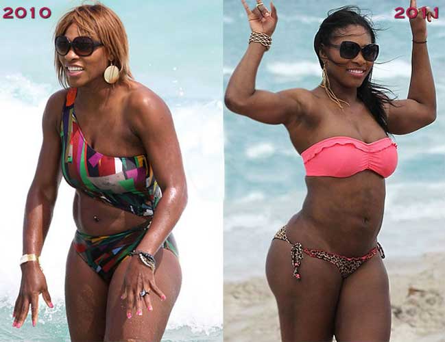 Serena williams plastic surgery