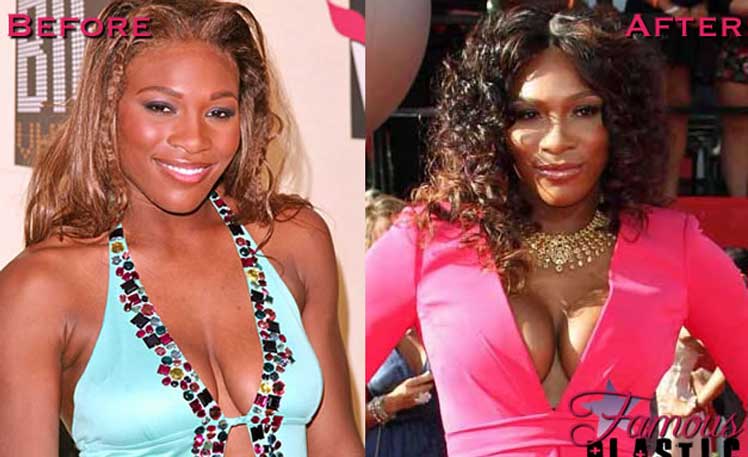 Serena williams plastic surgery