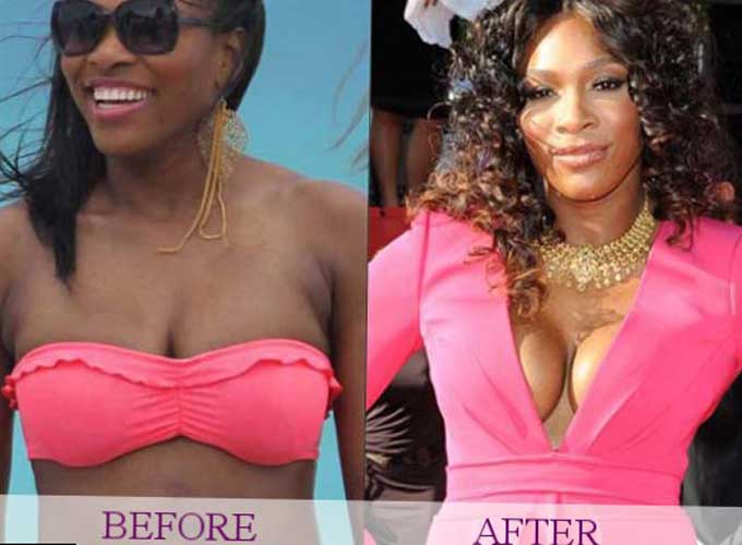 Serena williams plastic surgery