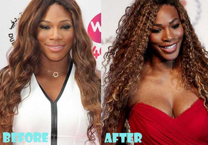 free serena williams plastic surgery