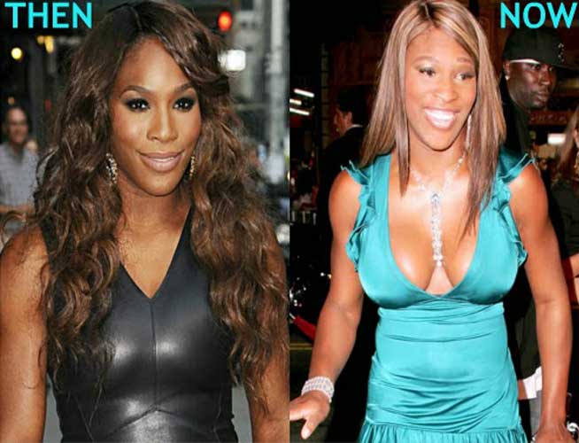 free serena williams plastic surgery