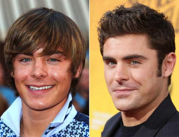 Zac Efron Plastic Surgery: Nose Job the Curious case of his Rhinoplasty