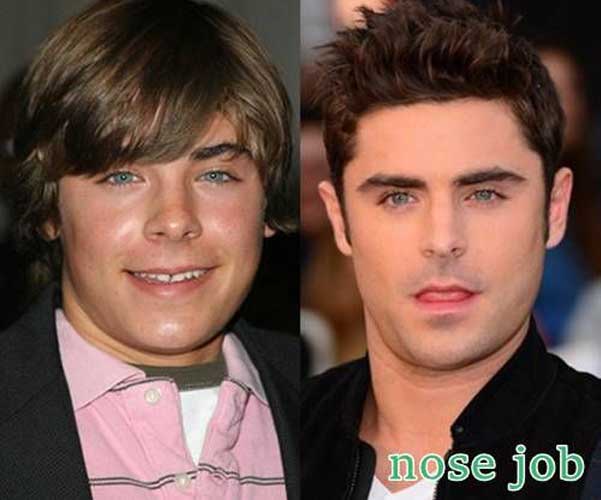 Zac Efron Plastic Surgery: Nose Job the Curious case of his Rhinoplasty