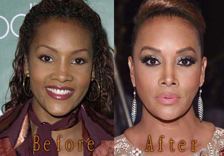 vivica fox plastic surgery