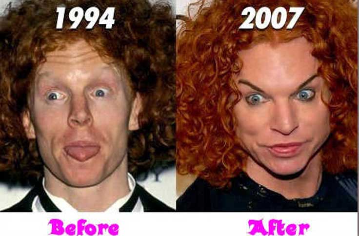 Carrot Top Plastic Surgery