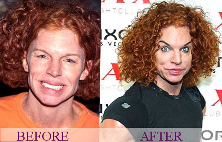 Carrot Top Plastic Surgery