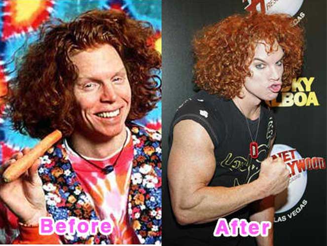 Carrot Top Plastic Surgery