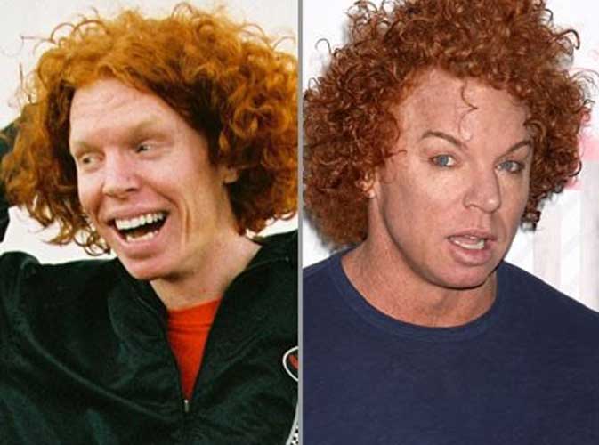 Carrot Top Plastic Surgery