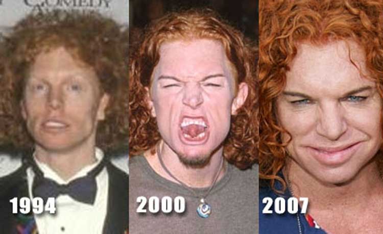 Carrot Top Plastic Surgery