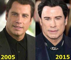 John Travolta Plastic Surgery: Facelift, Botox, Hair transplant