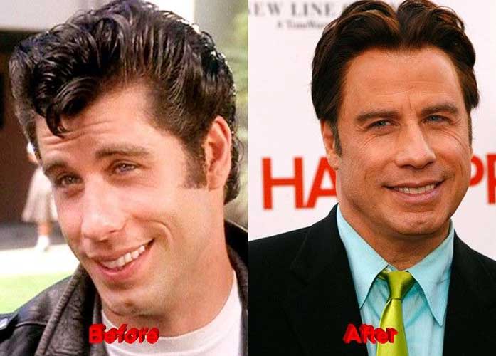 John Travolta plastic surgery