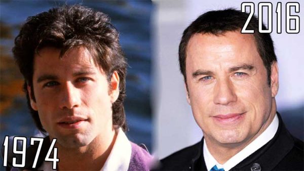 John Travolta Plastic Surgery: Facelift, Botox, Hair transplant