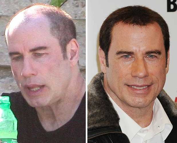 John Travolta plastic surgery