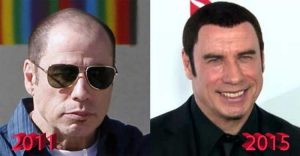 John Travolta Plastic Surgery: Facelift, Botox, Hair transplant