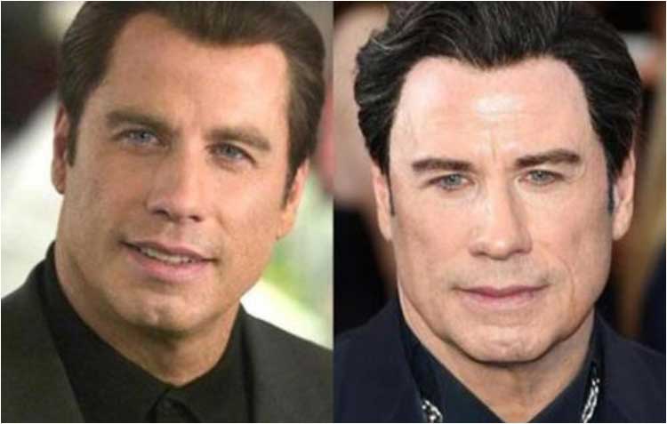 John Travolta plastic surgery 