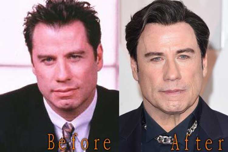 John Travolta Plastic Surgery: Facelift, Botox, Hair transplant