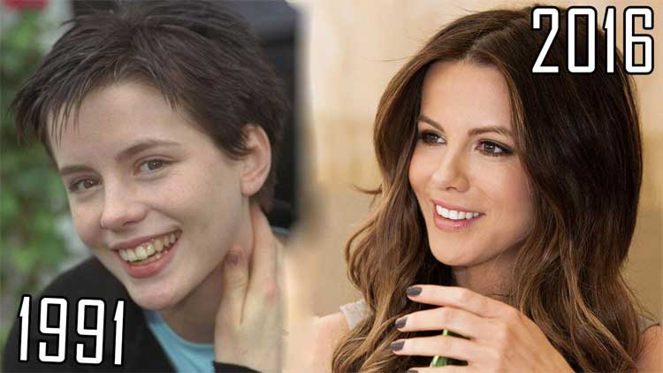 Kate Beckinsale Plastic Surgery 