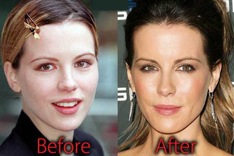 Kate Beckinsale Plastic Surgery