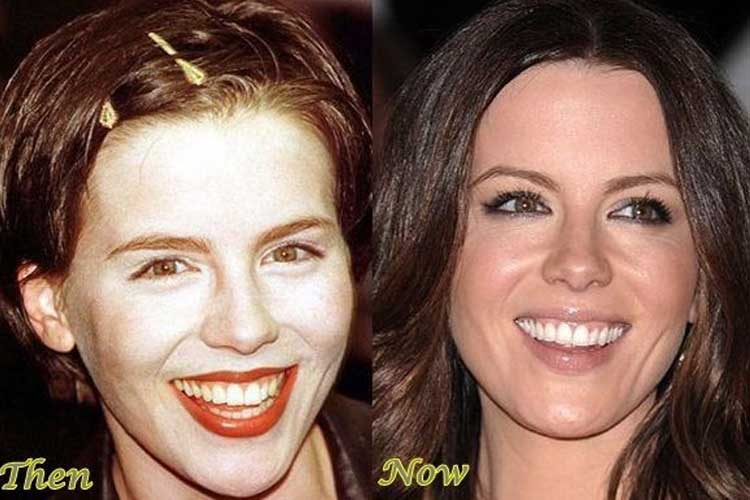 Kate Beckinsale Plastic Surgery