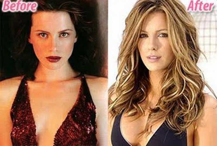 Kate Beckinsale Plastic Surgery 