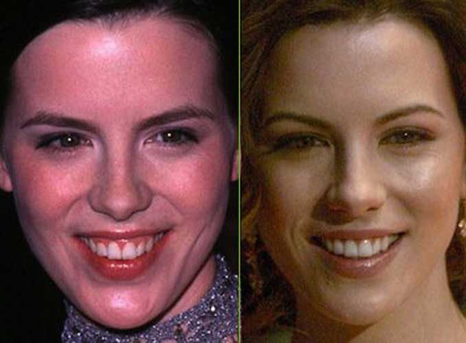 Kate Beckinsale Plastic Surgery