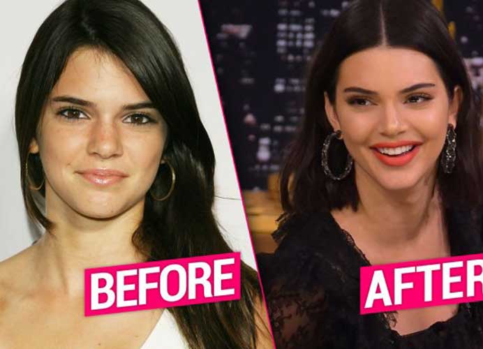 Kendall Jenner Plastic surgery 