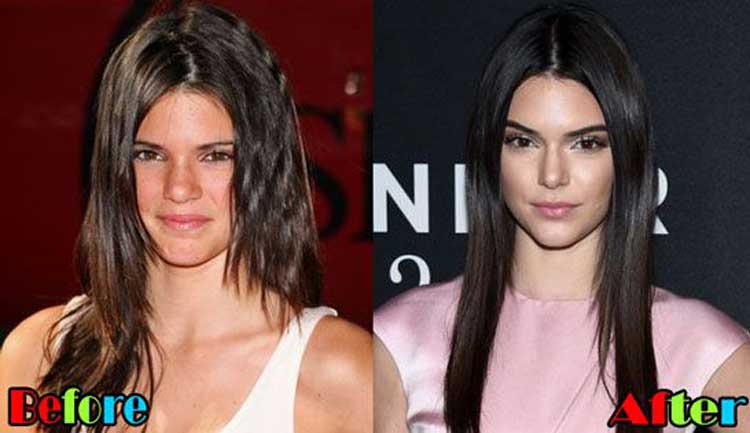 Kendall-Jenner-Plastic-surgery-2.jpg