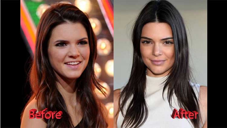 Kendall Jenner Plastic surgery 