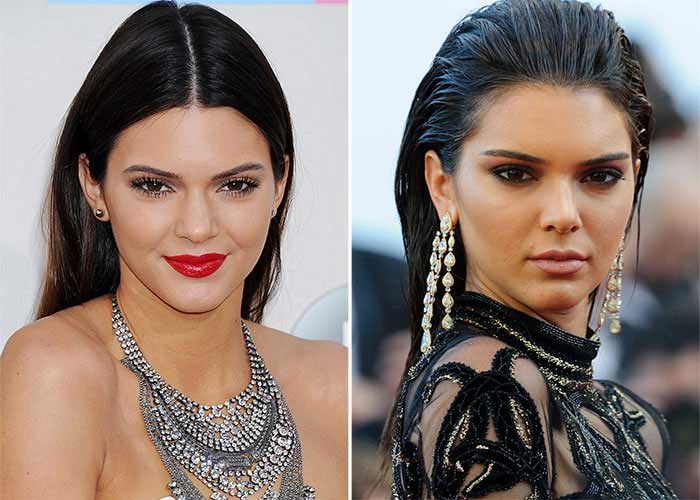 Kendall Jenner Plastic surgery 