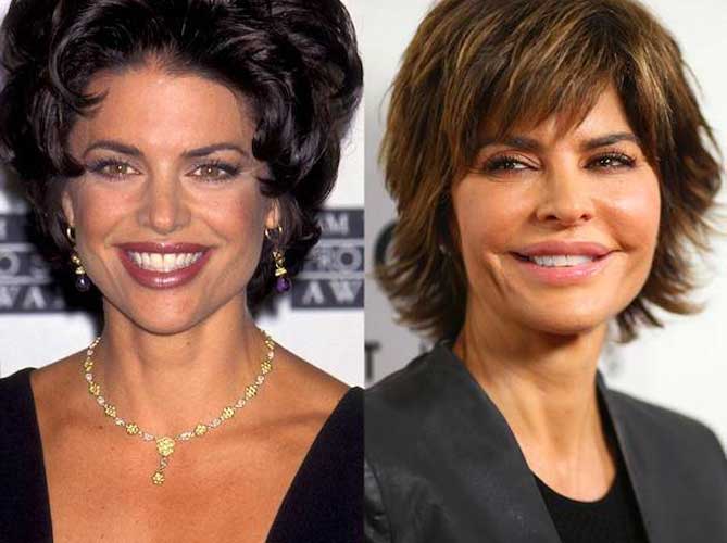 Lisa Rinna Plastic Surgery Botox Lip Fillers Photos | My XXX Hot Girl