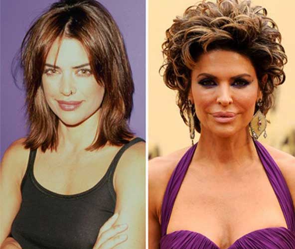 Lisa Rinna Plastic Surgery