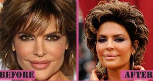 Lisa Rinna Plastic Surgery: Botox, Lip fillers, Photos After and Before