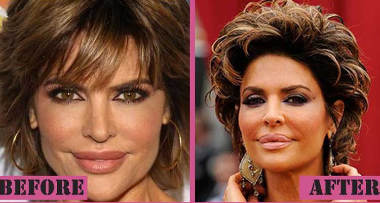 Lisa Rinna Plastic Surgery