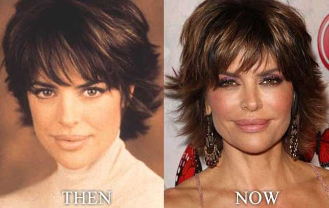 Lisa Rinna Plastic Surgery