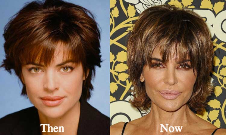 Lisa Rinna Plastic Surgery