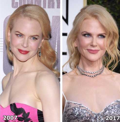 Nicole Kidman Plastic Surgery