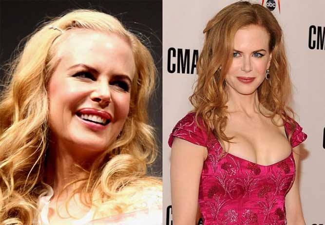 Nicole Kidman Plastic Surgery