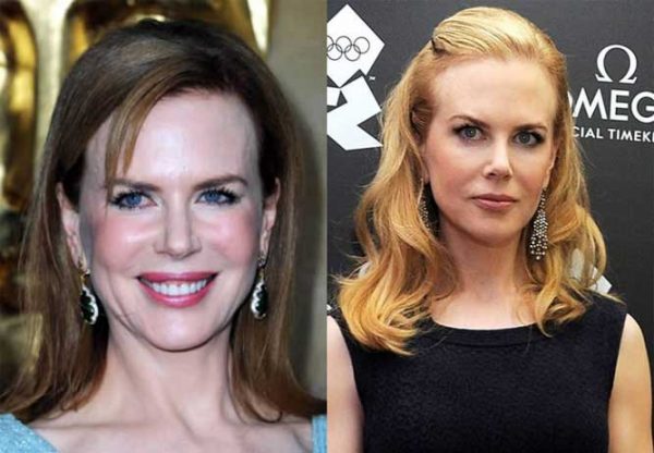 Nicole Kidman Plastic Surgery: Facelift, Lip Augmentation, Breast increase