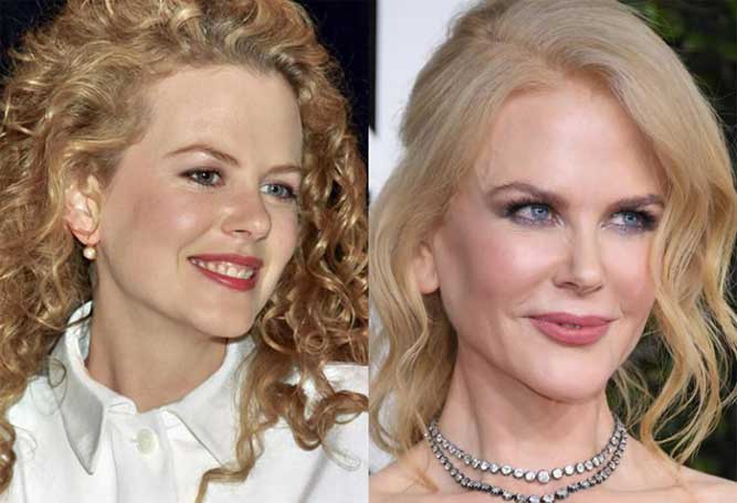 Nicole Kidman Plastic Surgery