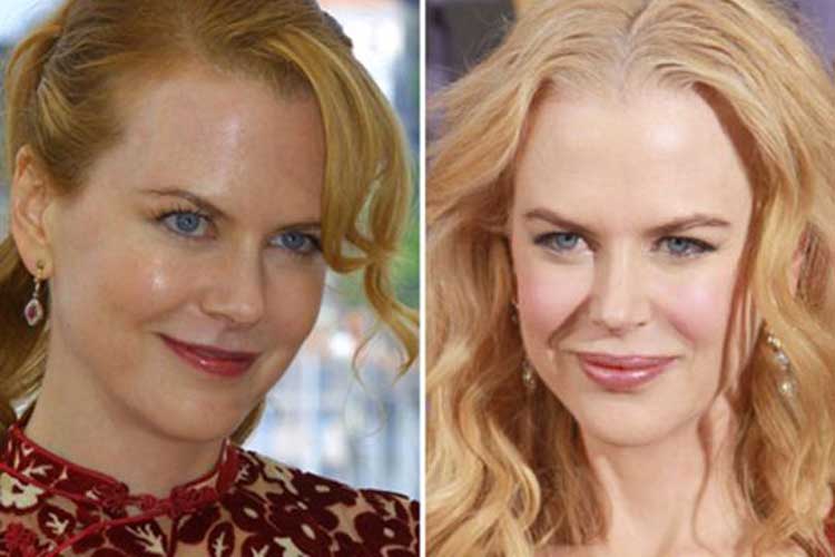 Nicole Kidman Plastic Surgery