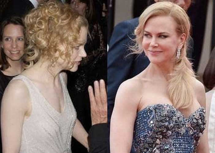 Nicole Kidman Plastic Surgery