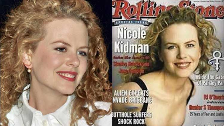 Nicole Kidman Plastic Surgery