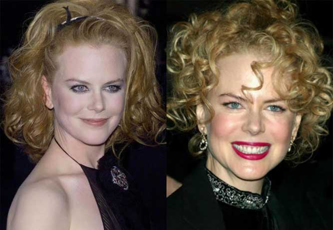 Nicole Kidman Plastic Surgery