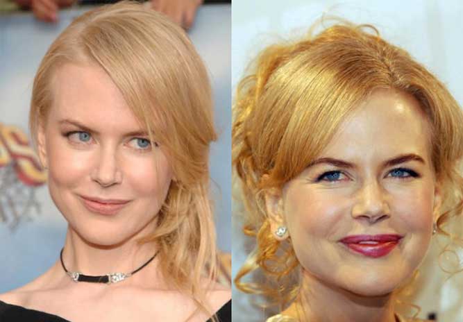 Nicole Kidman Plastic Surgery