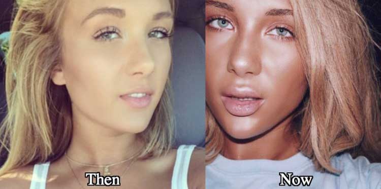 Niykee Heaton Plastic Surgery