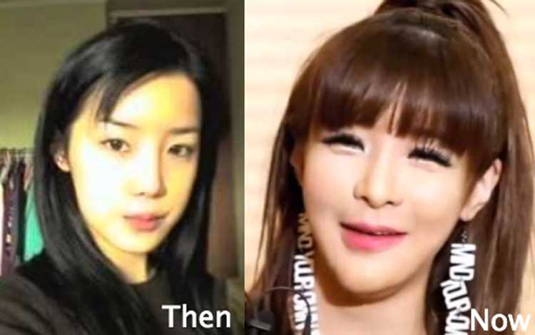 Park Bom Plastic Surgery: Eyelid Surgery, Nose Job, Chin Surgery