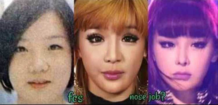 Park Bom Plastic Surgery: Eyelid Surgery, Nose Job, Chin Surgery